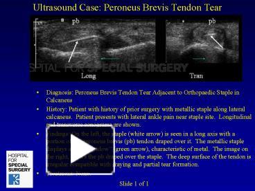 PPT – Ultrasound Case: Peroneus Brevis Tendon Tear PowerPoint ...