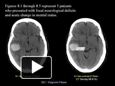 PPT – 8.1. Non-contrast CT Brain PowerPoint presentation | free to ...