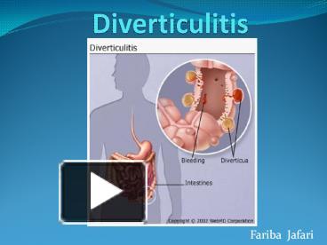 PPT – Diverticulitis PowerPoint presentation | free to view - id ...