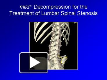 PPT – mild? Decompression for the Treatment of Lumbar Spinal Stenosis ...