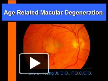 PPT – Age Related Macular Degeneration PowerPoint presentation | free ...