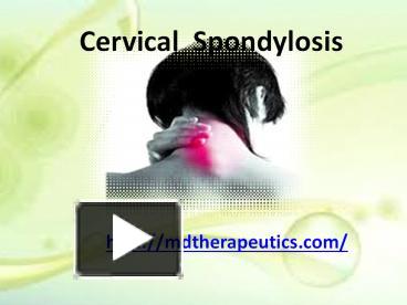 PPT – Cervical spondylosis PowerPoint presentation | free to download ...