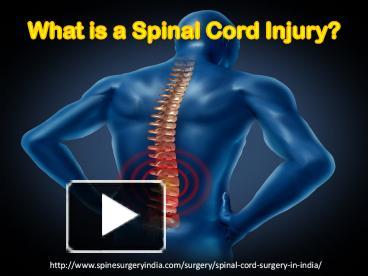 PPT – Spinal Cord Injury & Treatment PowerPoint presentation | free to ...