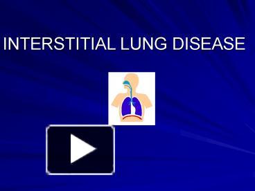 PPT – INTERSTITIAL LUNG DISEASE PowerPoint presentation | free to view ...