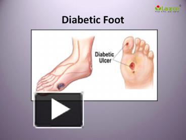 PPT – Diabetic Foot: Symptoms, Risks, Diagnosis, Treatment and ...