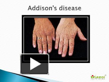 PPT – Addison's disease (Adrenal insufficiency): Symptoms, Causes and ...