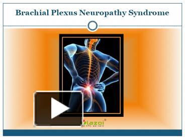 PPT – Brachial Plexus Neuropathy Syndrome: Symptoms, causes, diagnosis ...