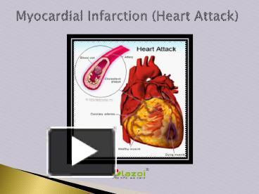 PPT – Myocardial Infarction (Heart Attack): Symptoms, Causes, Risk ...