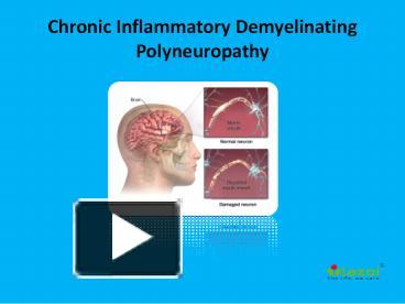 PPT – Chronic Inflammatory Demyelinating Polyneuropathy PowerPoint ...