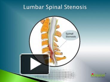 PPT – Lumbar Spinal Stenosis: Causes, Symptoms, Daignosis, Prevention ...