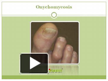 PPT – Onychomycosis: Causes, Symptoms, Daignosis, Prevention and ...