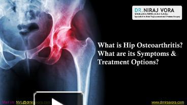 PPT – What is Hip Osteoarthritis? What are its Symptoms & Treatment ...