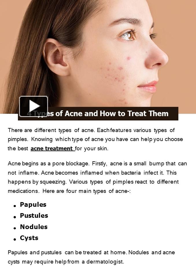 PPT – 4 Types of Acne and How to Treat Them PowerPoint presentation ...