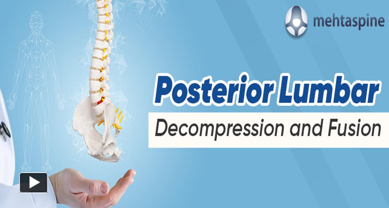 PPT – Posterior Lumbar Decompression and Fusion (PLDF) PowerPoint ...