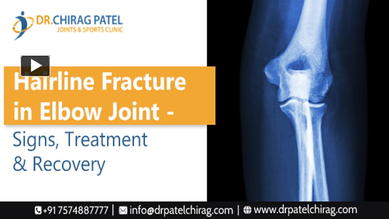 PPT – Understanding Hairline Fractures in the Elbow Joint | Dr. Chirag ...