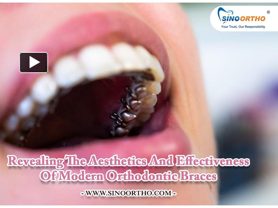 PPT – Revealing The Aesthetics And Effectiveness Of Modern Orthodontic ...