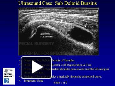 PPT – Ultrasound Case: Sub Deltoid Bursitis PowerPoint presentation ...